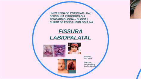 fissura labiopalatina-4